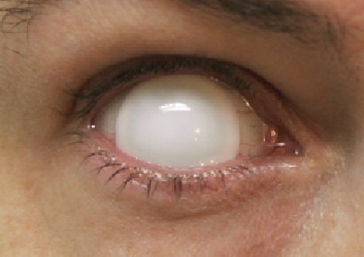 Белые глаза Элджея: болезнь, элемент образа или рэп-понты?