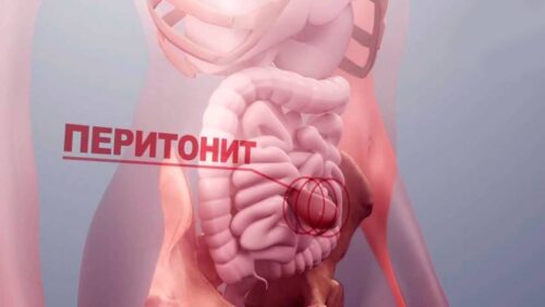 Перитонит